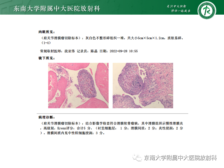 影像PPT - 【PPT】滑膜软骨瘤病-2 影像PPT - 【PPT】滑膜软骨瘤病-2