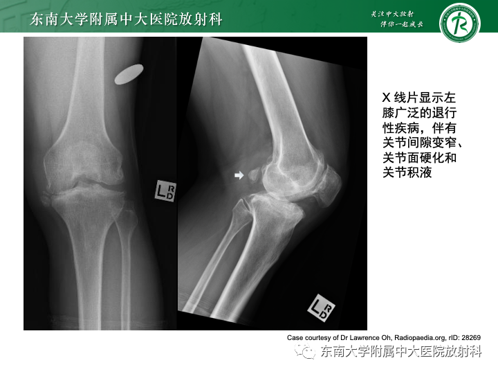 影像PPT - 【PPT】滑膜软骨瘤病-16 影像PPT - 【PPT】滑膜软骨瘤病-16