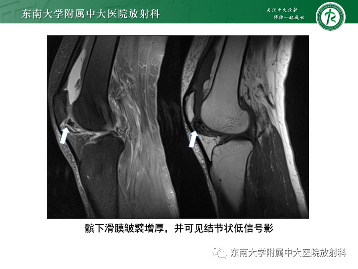 影像PPT - 【PPT】滑膜软骨瘤病-18 影像PPT - 【PPT】滑膜软骨瘤病-18