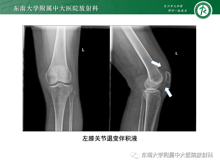 影像PPT - 【PPT】滑膜软骨瘤病-20 影像PPT - 【PPT】滑膜软骨瘤病-20