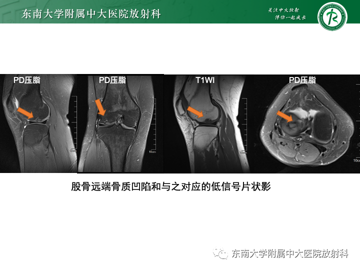 影像PPT - 【PPT】滑膜软骨瘤病-22 影像PPT - 【PPT】滑膜软骨瘤病-22