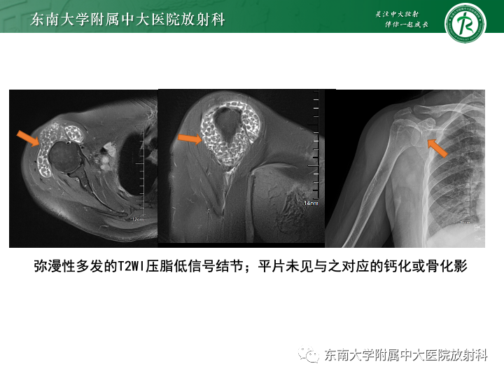 影像PPT - 【PPT】滑膜软骨瘤病-25 影像PPT - 【PPT】滑膜软骨瘤病-25