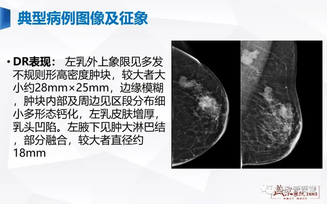 影像PPT - 【PPT】乳腺疾病病例读片-4 影像PPT - 【PPT】乳腺疾病病例读片-4