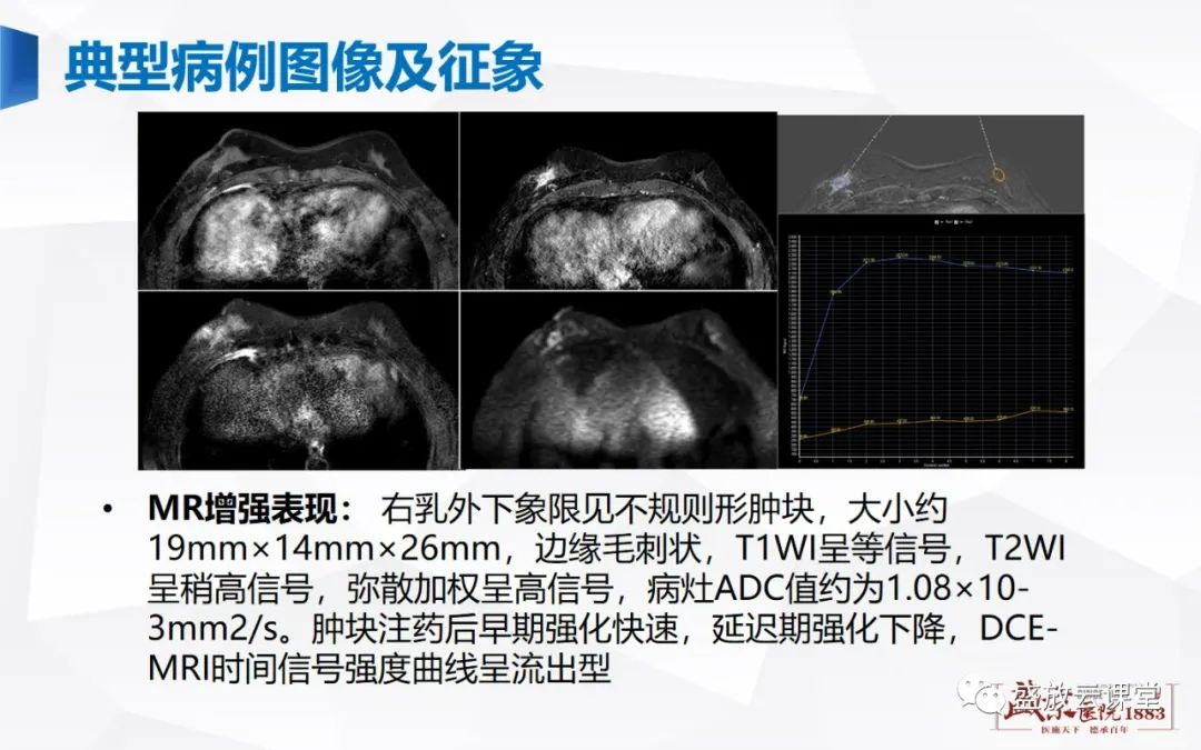 影像PPT - 【PPT】乳腺疾病病例读片-8 影像PPT - 【PPT】乳腺疾病病例读片-8