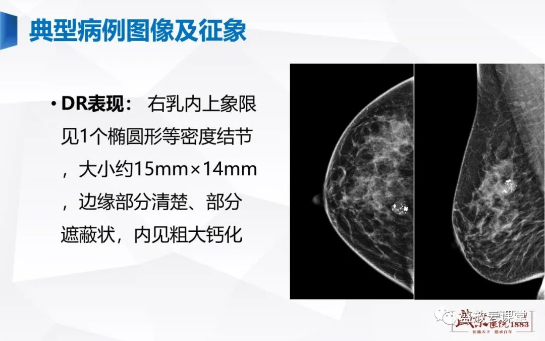 影像PPT - 【PPT】乳腺疾病病例读片-14 影像PPT - 【PPT】乳腺疾病病例读片-14