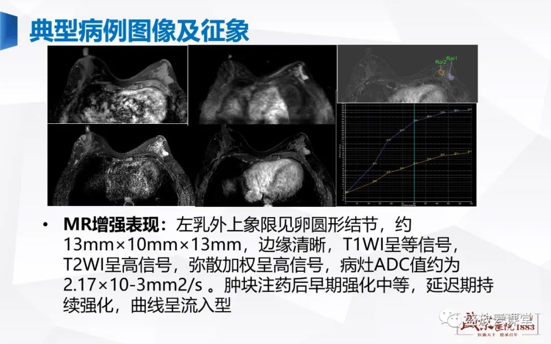 影像PPT - 【PPT】乳腺疾病病例读片-18 影像PPT - 【PPT】乳腺疾病病例读片-18