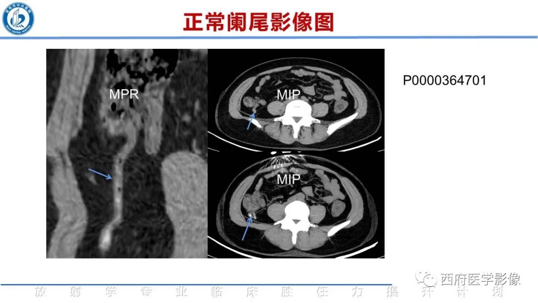 影像PPT - 【PPT】阑尾解剖及阑尾炎影像诊断-12