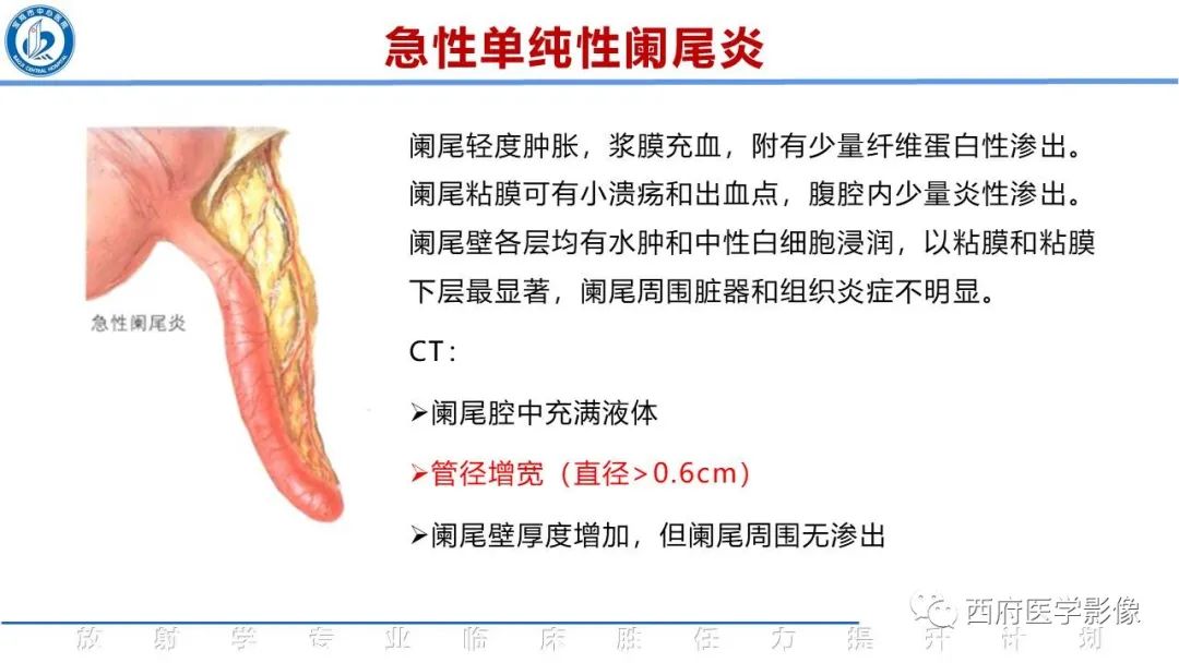 影像PPT - 【PPT】阑尾解剖及阑尾炎影像诊断-13