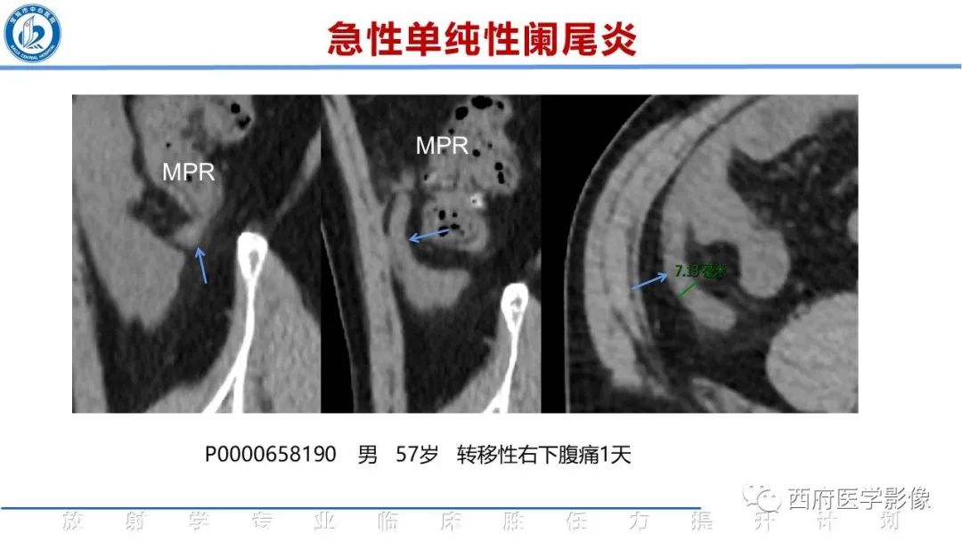 影像PPT - 【PPT】阑尾解剖及阑尾炎影像诊断-14