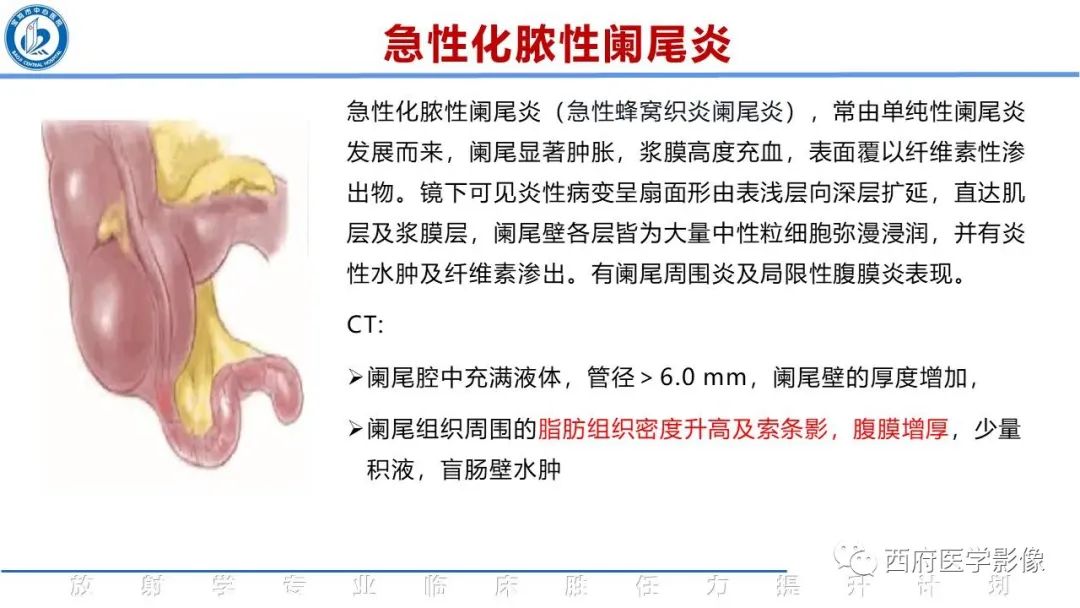 影像PPT - 【PPT】阑尾解剖及阑尾炎影像诊断-15