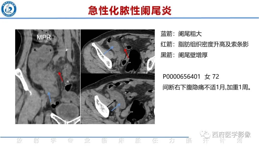 影像PPT - 【PPT】阑尾解剖及阑尾炎影像诊断-16