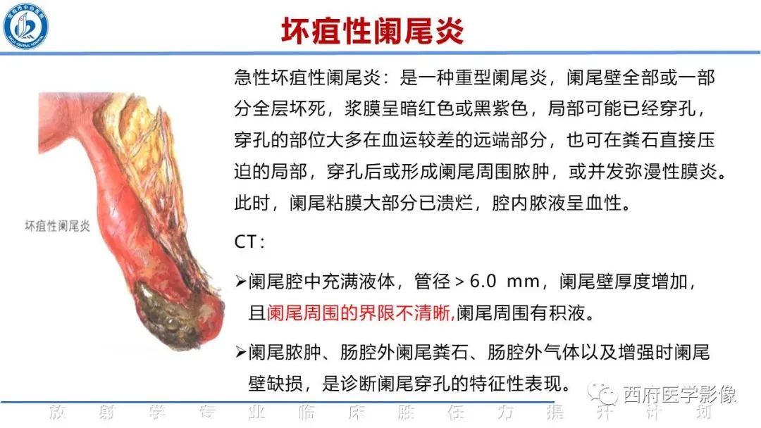 影像PPT - 【PPT】阑尾解剖及阑尾炎影像诊断-17