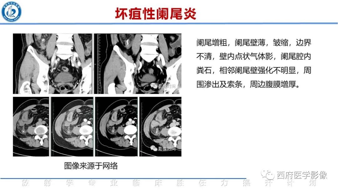影像PPT - 【PPT】阑尾解剖及阑尾炎影像诊断-18