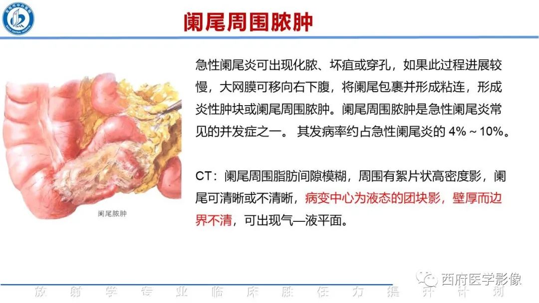 影像PPT - 【PPT】阑尾解剖及阑尾炎影像诊断-19