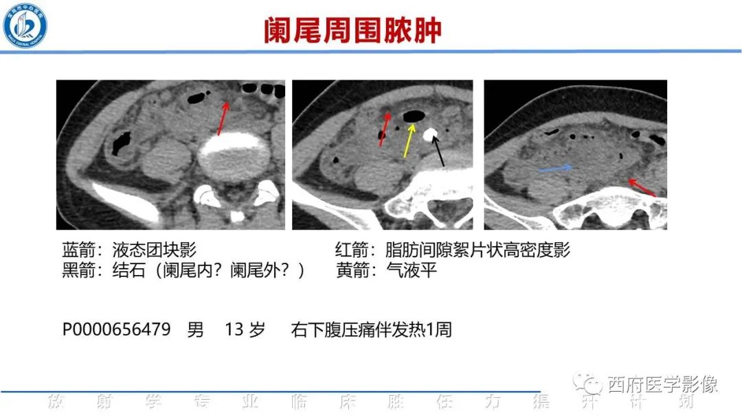 影像PPT - 【PPT】阑尾解剖及阑尾炎影像诊断-20
