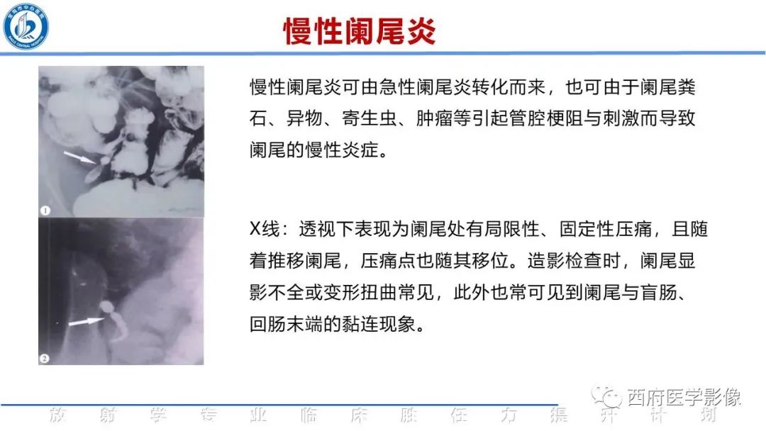 影像PPT - 【PPT】阑尾解剖及阑尾炎影像诊断-23