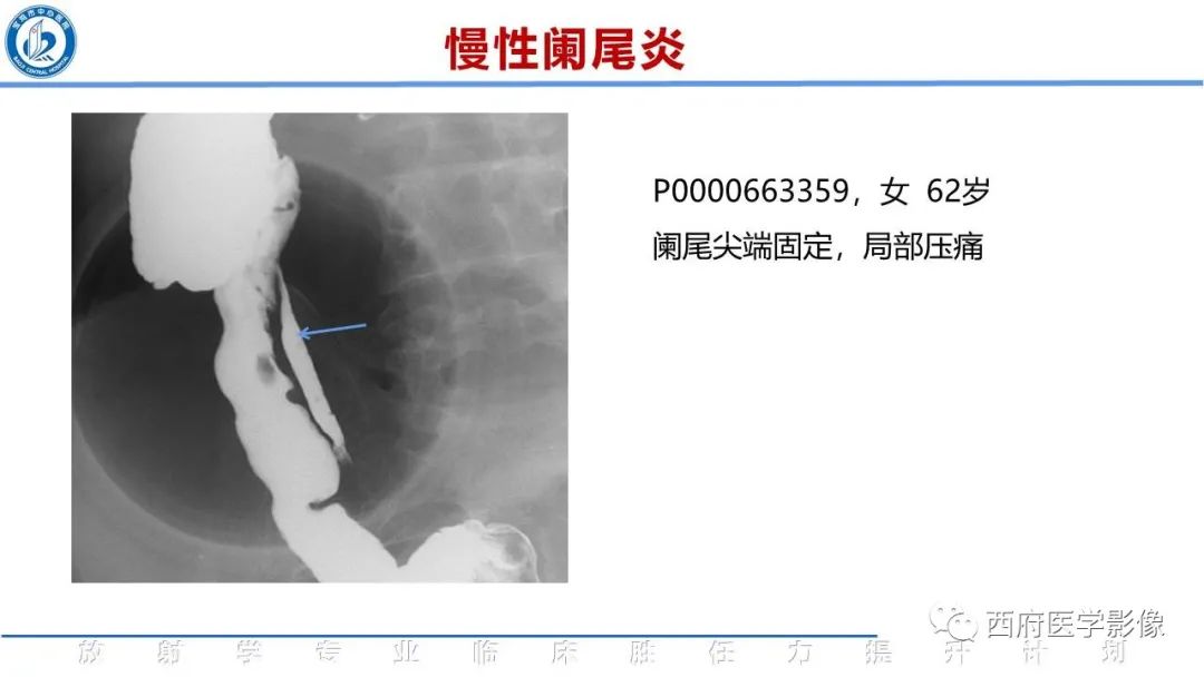 影像PPT - 【PPT】阑尾解剖及阑尾炎影像诊断-24