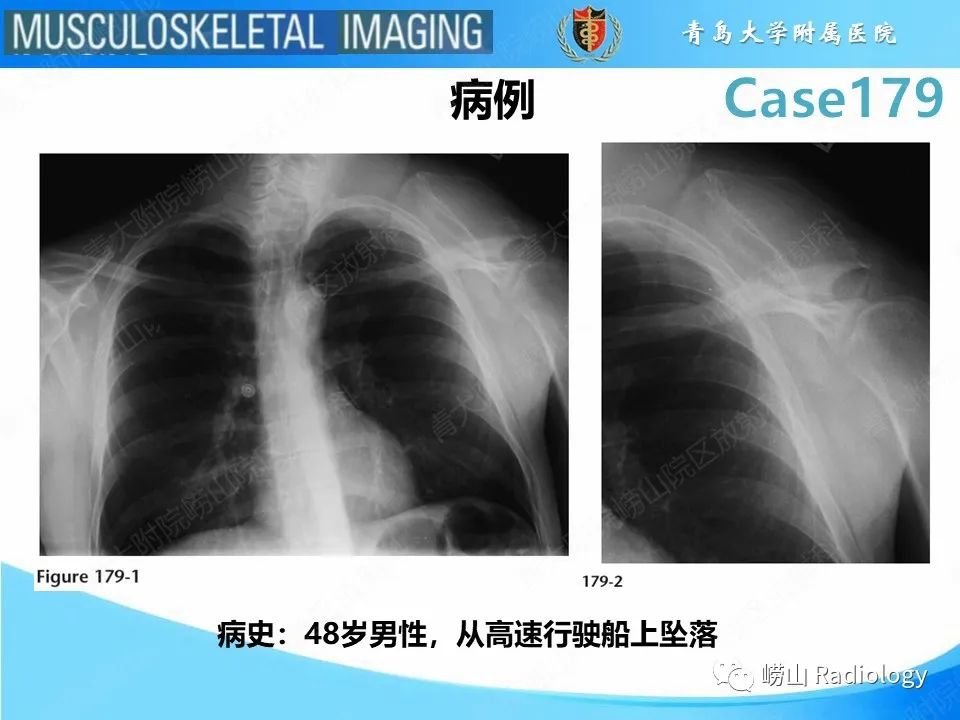 影像PPT - 【PPT】肩胛胸壁分离-2