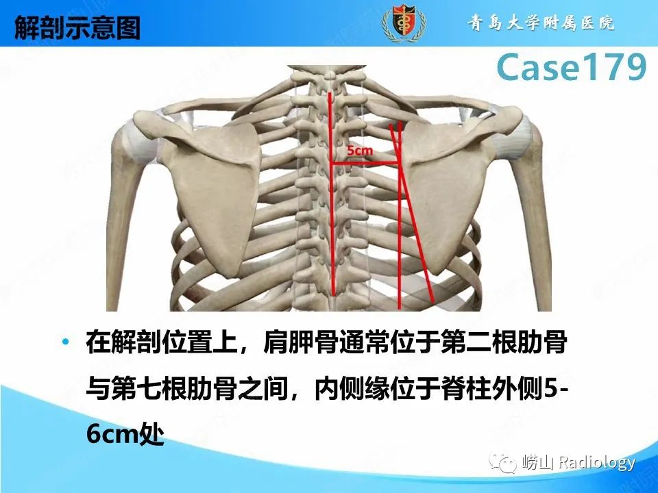 影像PPT - 【PPT】肩胛胸壁分离-12