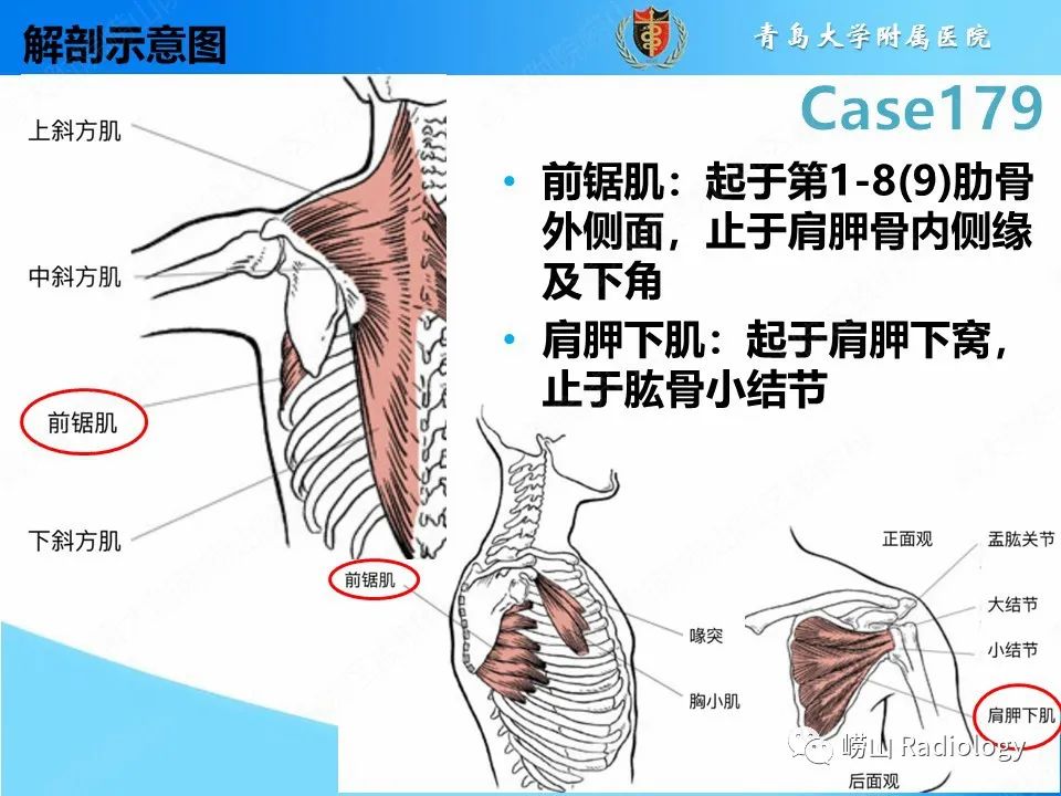影像PPT - 【PPT】肩胛胸壁分离-14