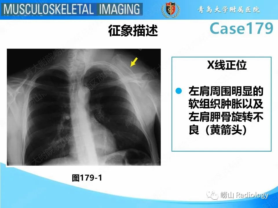 影像PPT - 【PPT】肩胛胸壁分离-20