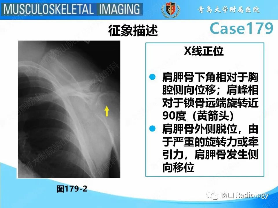 影像PPT - 【PPT】肩胛胸壁分离-21