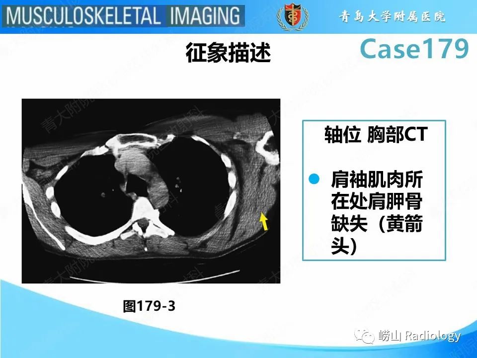 影像PPT - 【PPT】肩胛胸壁分离-22