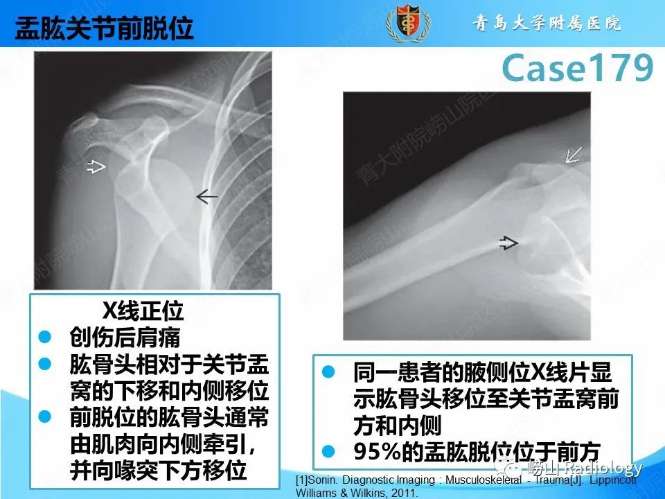 影像PPT - 【PPT】肩胛胸壁分离-25