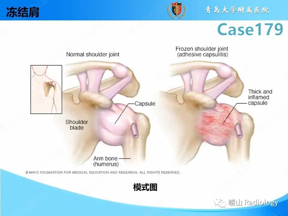 影像PPT - 【PPT】肩胛胸壁分离-27