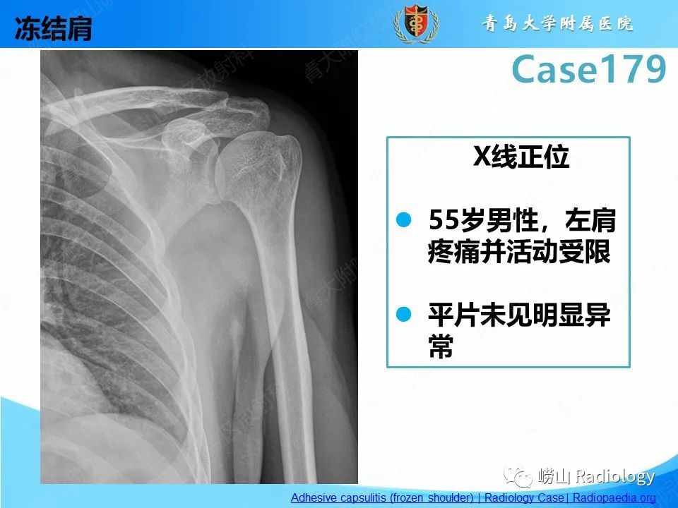 影像PPT - 【PPT】肩胛胸壁分离-28