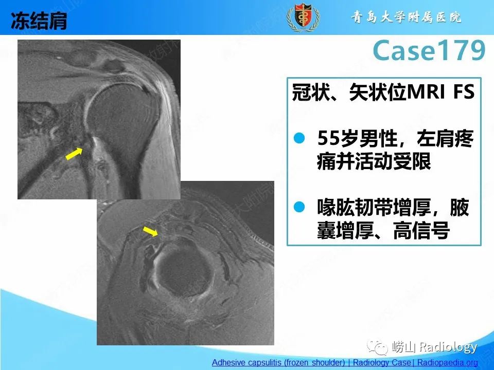 影像PPT - 【PPT】肩胛胸壁分离-29