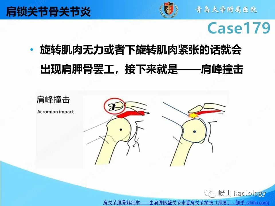 影像PPT - 【PPT】肩胛胸壁分离-30
