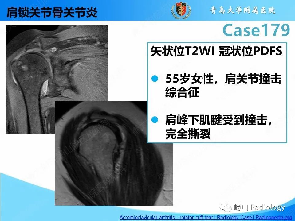 影像PPT - 【PPT】肩胛胸壁分离-31