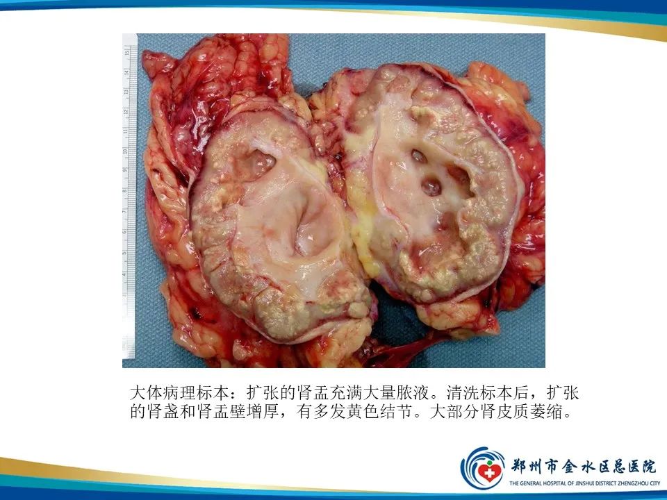 影像PPT - 【PPT】黄色肉芽肿性肾盂肾炎影像表现-9