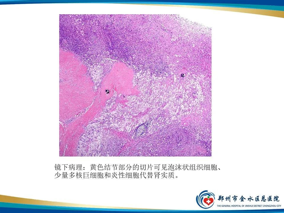 影像PPT - 【PPT】黄色肉芽肿性肾盂肾炎影像表现-10