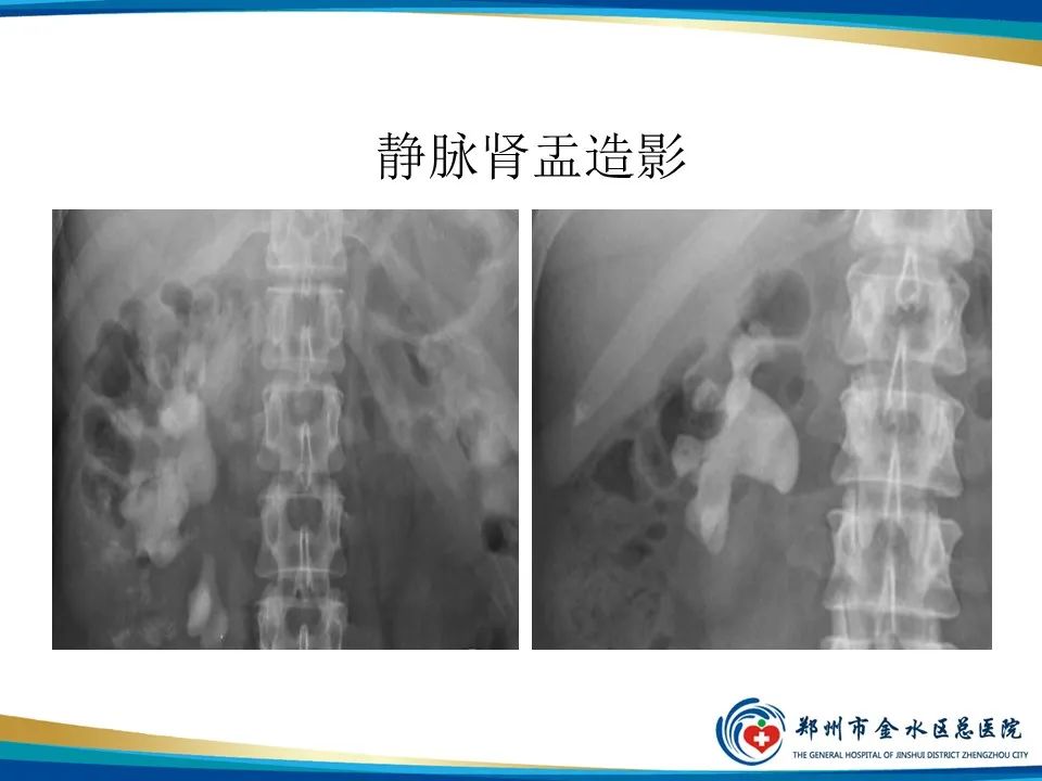 影像PPT - 【PPT】黄色肉芽肿性肾盂肾炎影像表现-14