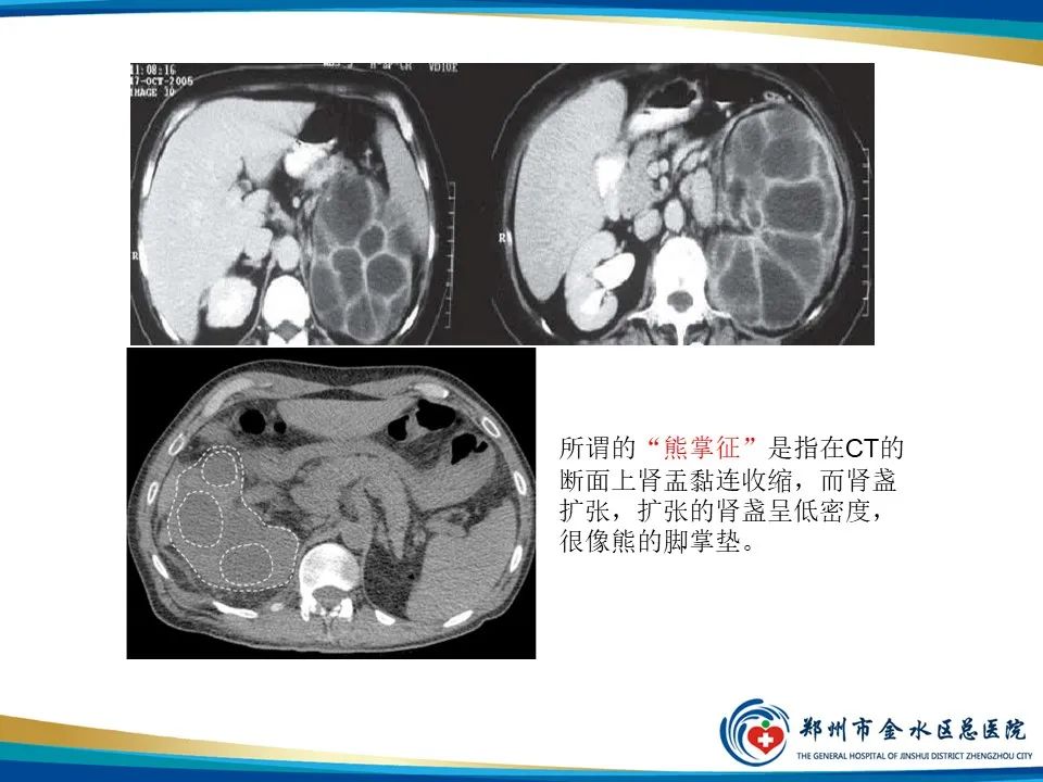 影像PPT - 【PPT】黄色肉芽肿性肾盂肾炎影像表现-17