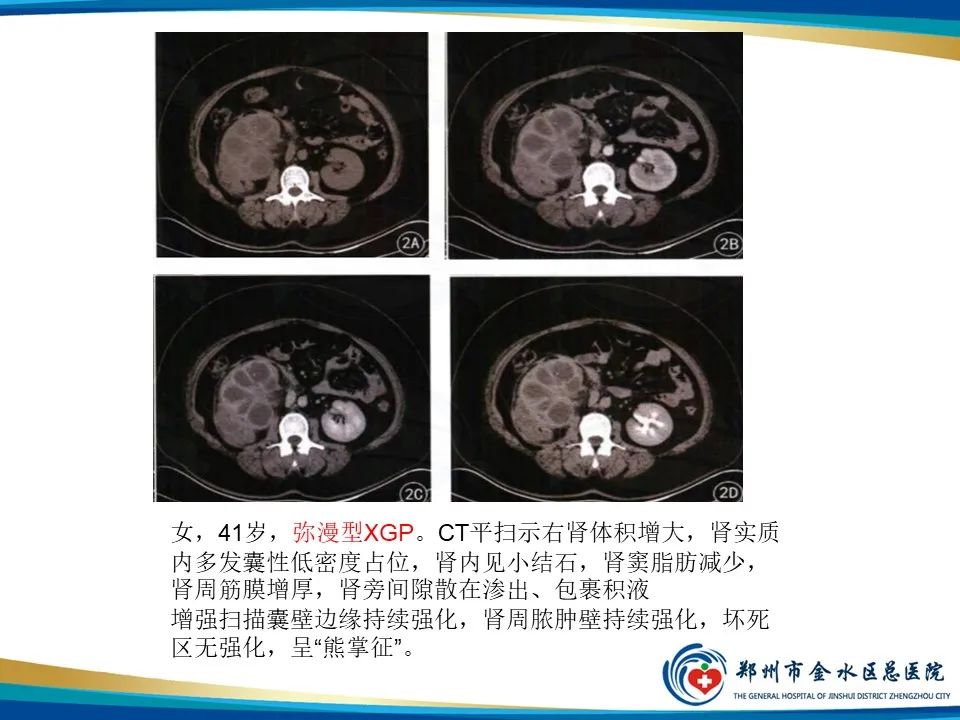 影像PPT - 【PPT】黄色肉芽肿性肾盂肾炎影像表现-18
