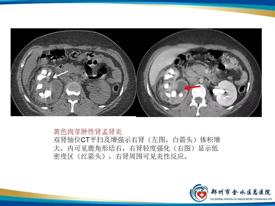 影像PPT - 【PPT】黄色肉芽肿性肾盂肾炎影像表现-19