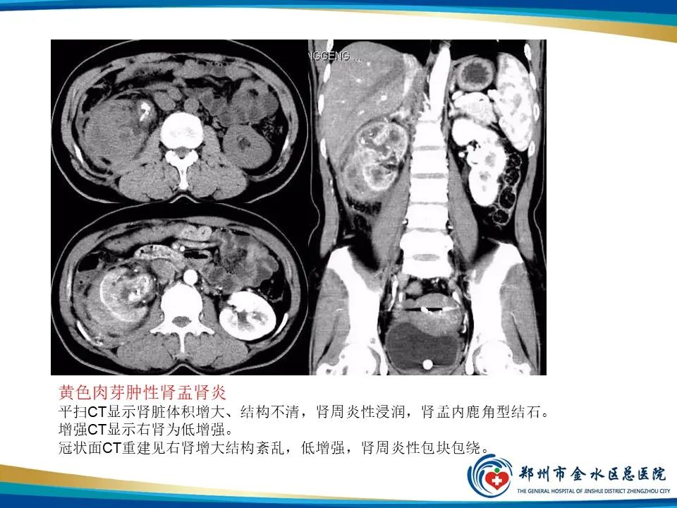 影像PPT - 【PPT】黄色肉芽肿性肾盂肾炎影像表现-20