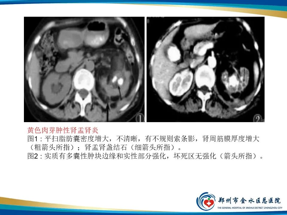 影像PPT - 【PPT】黄色肉芽肿性肾盂肾炎影像表现-21