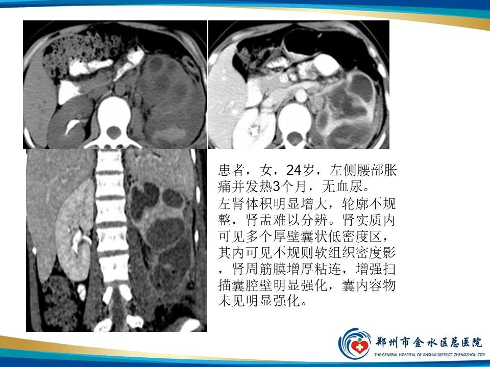 影像PPT - 【PPT】黄色肉芽肿性肾盂肾炎影像表现-22