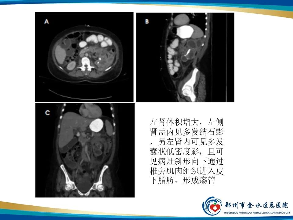 影像PPT - 【PPT】黄色肉芽肿性肾盂肾炎影像表现-23