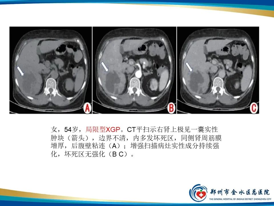 影像PPT - 【PPT】黄色肉芽肿性肾盂肾炎影像表现-24