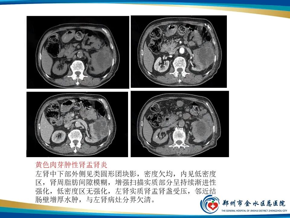 影像PPT - 【PPT】黄色肉芽肿性肾盂肾炎影像表现-25