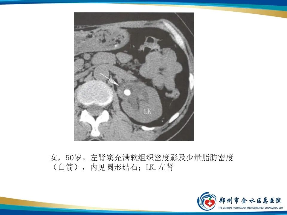 影像PPT - 【PPT】黄色肉芽肿性肾盂肾炎影像表现-26
