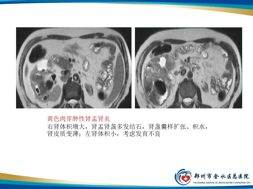 影像PPT - 【PPT】黄色肉芽肿性肾盂肾炎影像表现-28