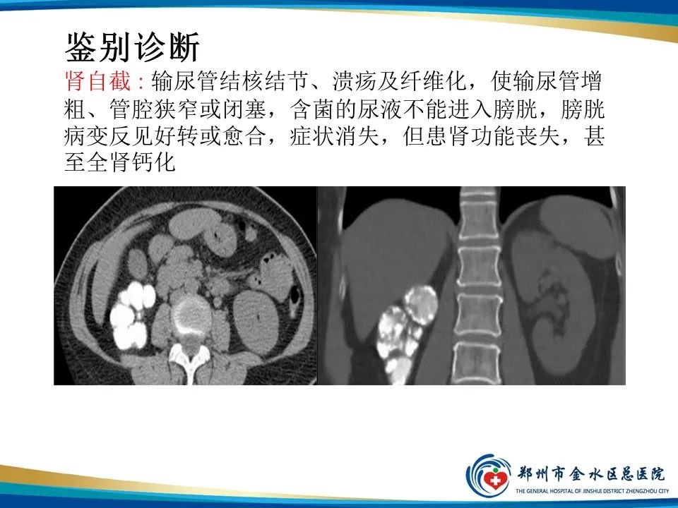影像PPT - 【PPT】黄色肉芽肿性肾盂肾炎影像表现-30