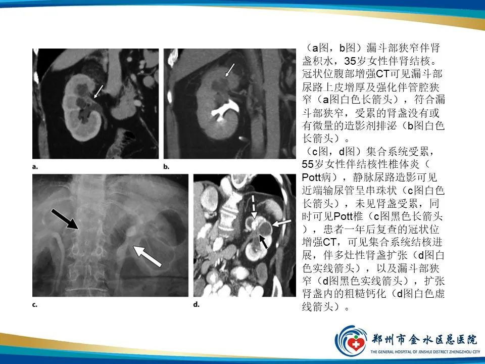 影像PPT - 【PPT】黄色肉芽肿性肾盂肾炎影像表现-31