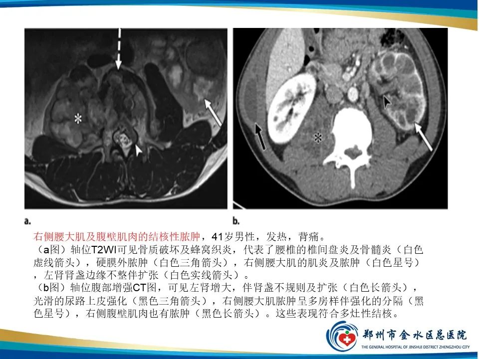 影像PPT - 【PPT】黄色肉芽肿性肾盂肾炎影像表现-32